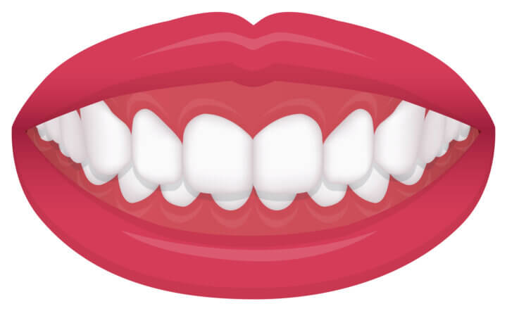 インビザラインで出っ歯を治すときに失敗しないための3ポイント