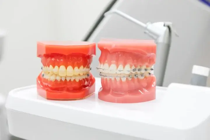 インビザラインとワイヤー矯正はそもそも仕組みが違う