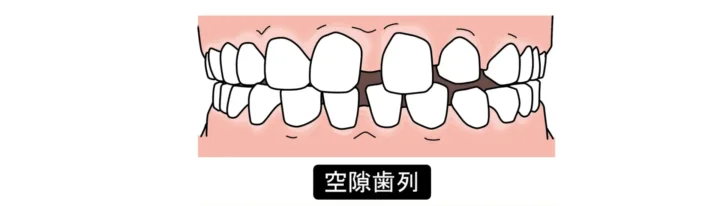 すきっ歯は大人になってからでも矯正で治せる？