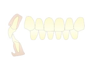 受け口(しゃくれ)はマウスピース矯正で治る?保険治療を徹底解説|芦屋M&S歯科・矯正クリニック