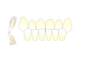 受け口(しゃくれ)はマウスピース矯正で治る?保険治療を徹底解説|芦屋M&S歯科・矯正クリニック