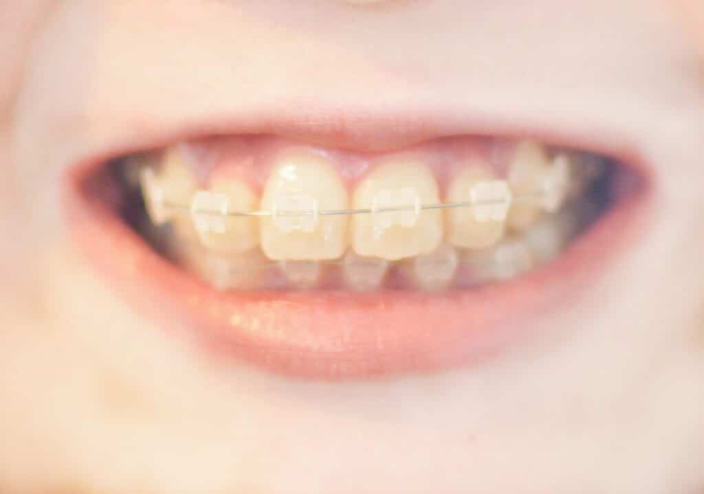部分矯正で出っ歯は治せる？できる症例・できない症例を現役歯科医が解説