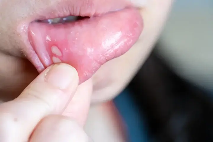 しゃくれ矯正治療に伴うリスクと注意点