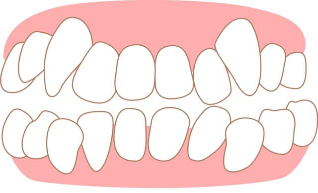 八重歯とは？犬歯とはどんな違い？