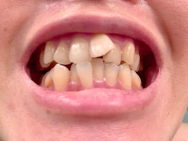 乱杭歯の特徴