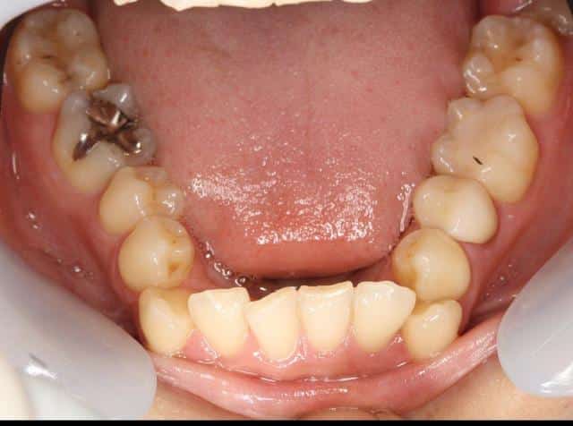 八重歯の特徴