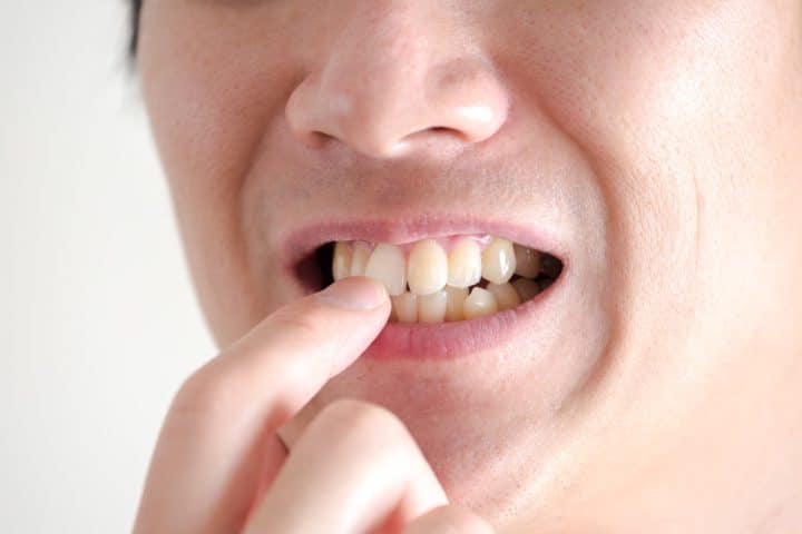 出っ歯の診断基準