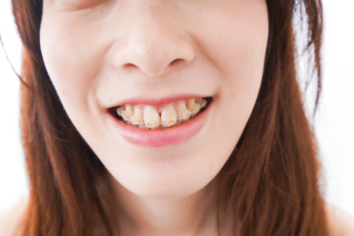 出っ歯で暮らす