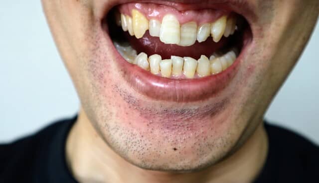 超重度の歯並びの場合のリスク