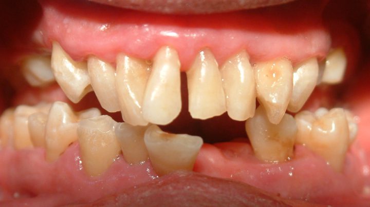 歯周病による制限