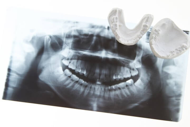 マウスピース矯正では難しいとされる歯並び症例と対策方法