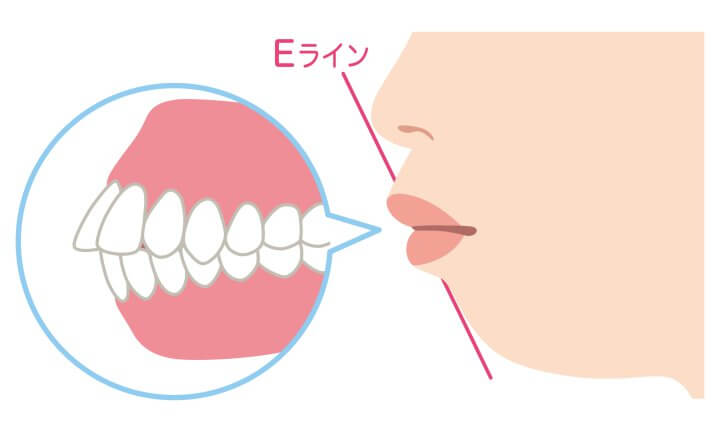 ひどい出っ歯とは？