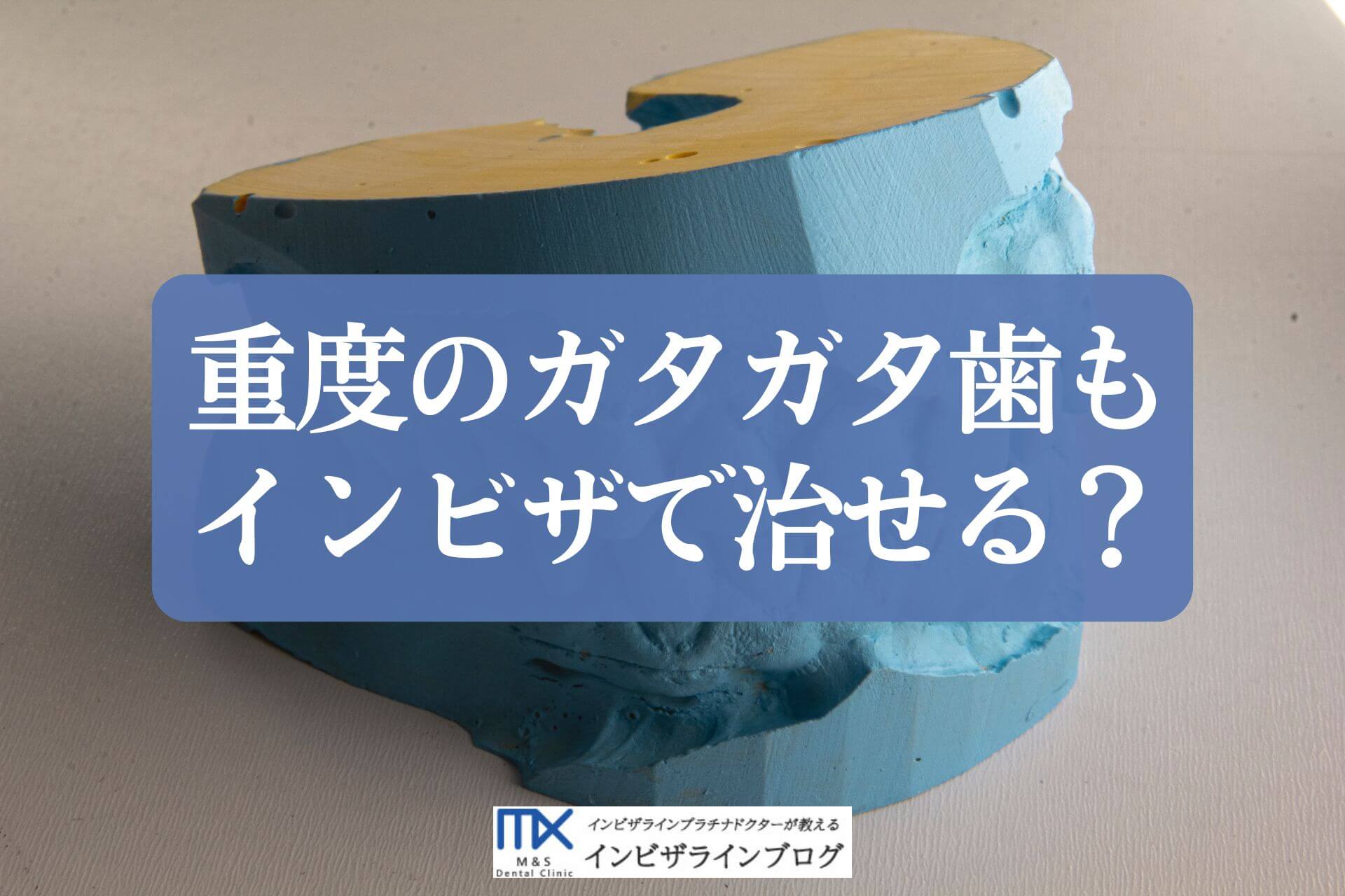 インビザラインで叢生（ガタガタ歯）はどこまで治せる？重度も改善できるか歯科医が解説！