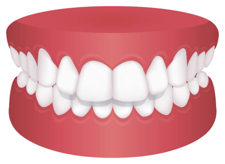 なぜ必要？バイトランプが過蓋咬合（ディープバイト）を治すメカニズム