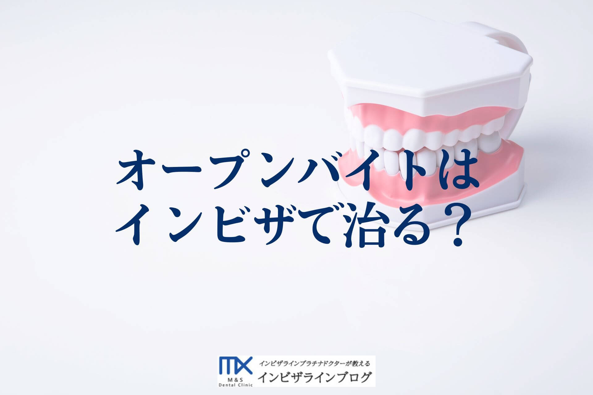 オープンバイトは インビザで治る？