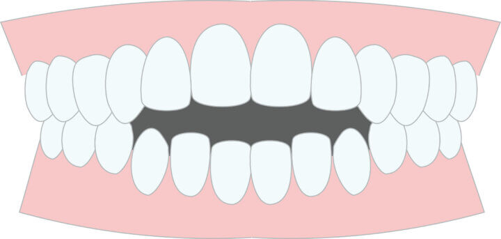 インビザラインで開咬は治る？