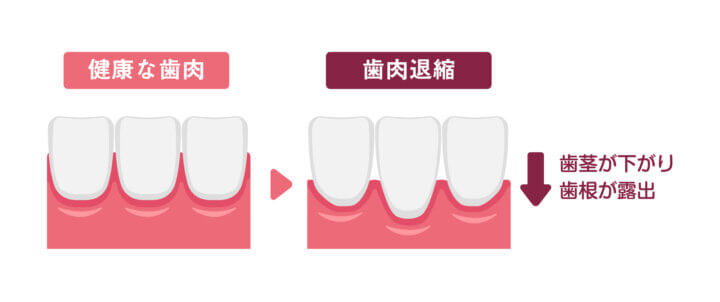 矯正中に歯茎が下がっている?歯肉退縮とインビザラインの関係