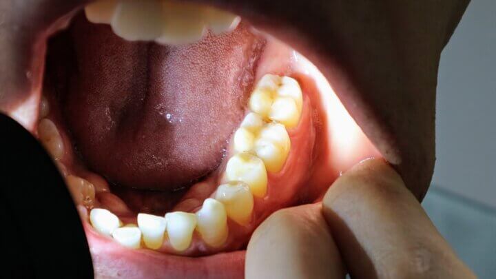 遠心移動が使われる代表的な歯並びへの活用手法は?