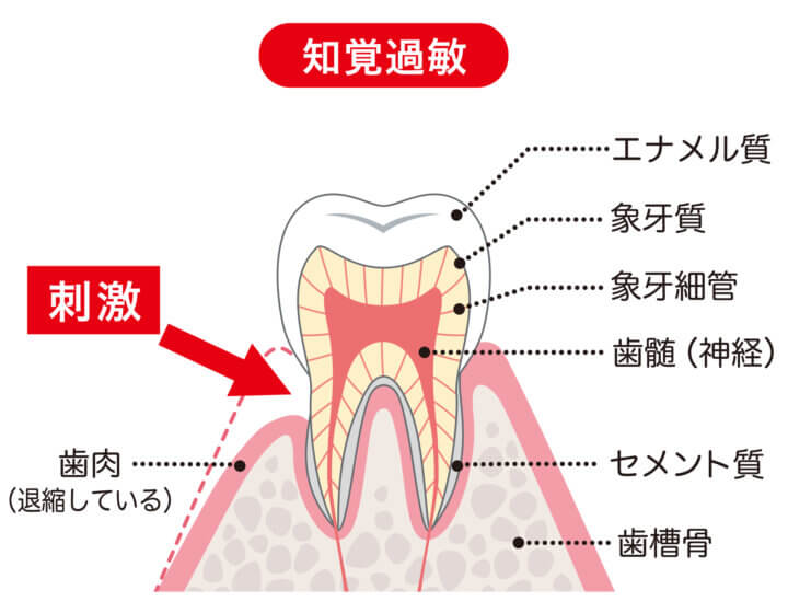 インビザラインで歯がしみるのは知覚過敏?