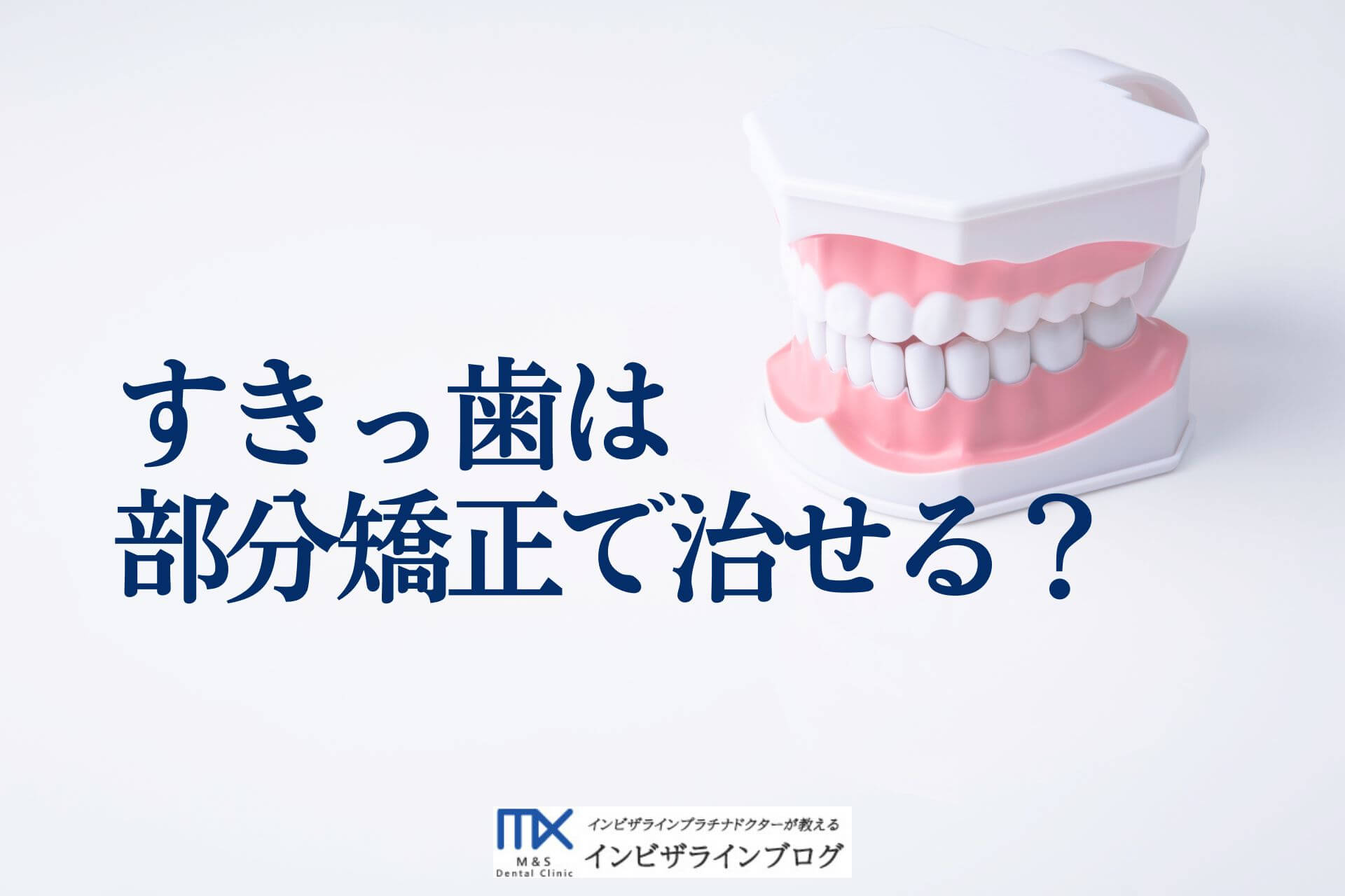 すきっ歯は前歯だけの矯正で治せる？判断基準・費用相場・後戻り防止まで解説