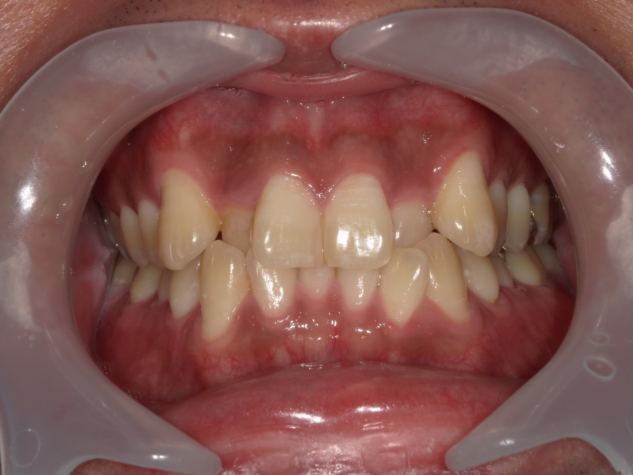 正面のビフォー画像
