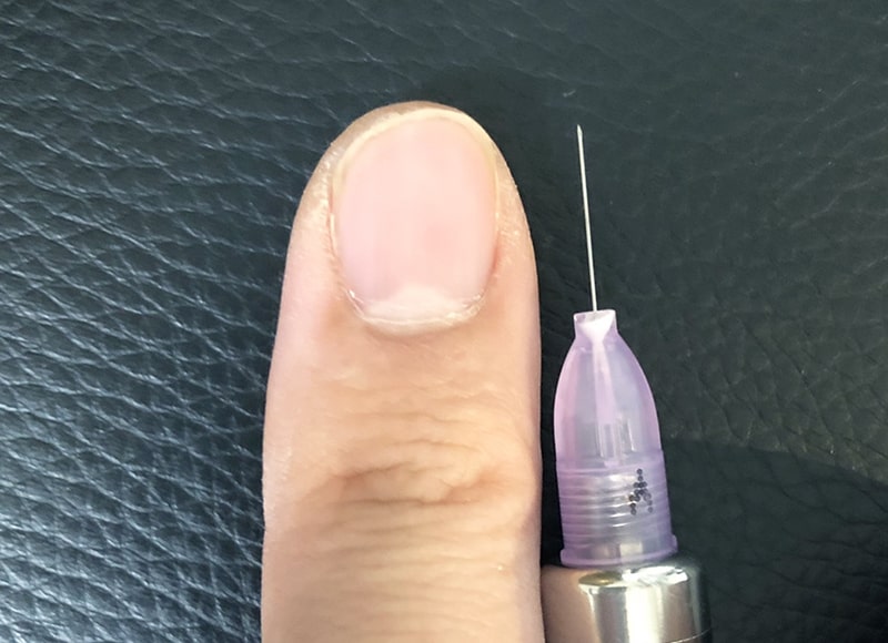 35ゲージ(0.2mm)の細い麻酔針